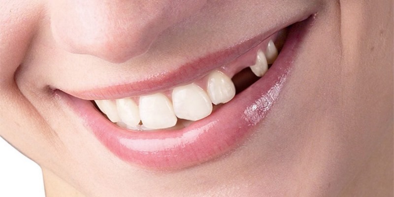 Ý nghĩa chi tiết đằng sau giấc mơ thấy răng rụng